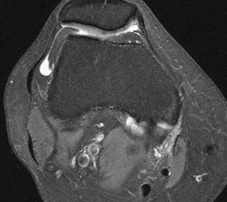 Figure 5 for case Partial tear of the tendon of the medial head of the gastrocnemius muscle ( RID2921 )